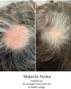 Advanced Hair System Kit Tratamento de Regeneração Capilar