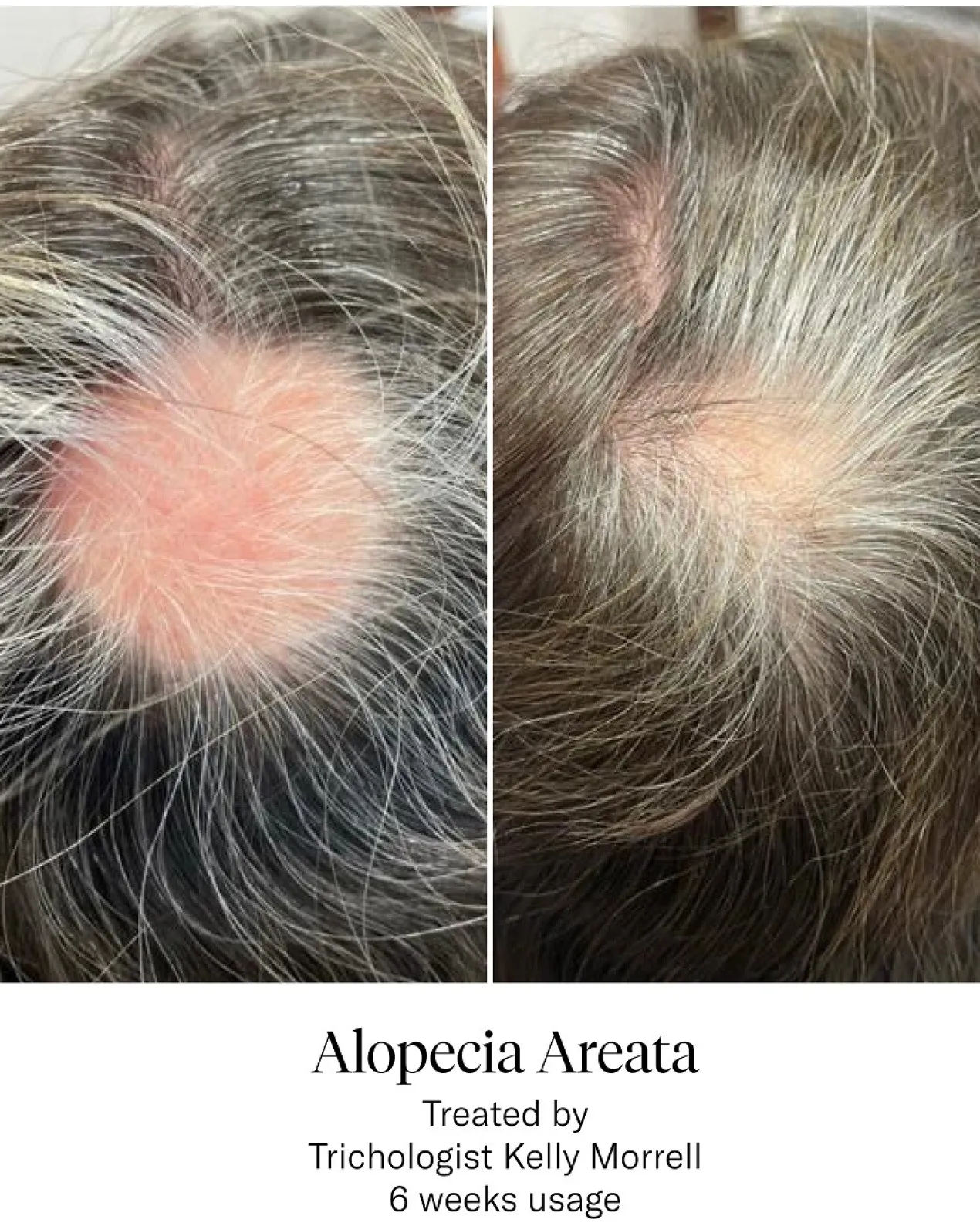 Advanced Hair System Kit Tratamento de Regeneração Capilar