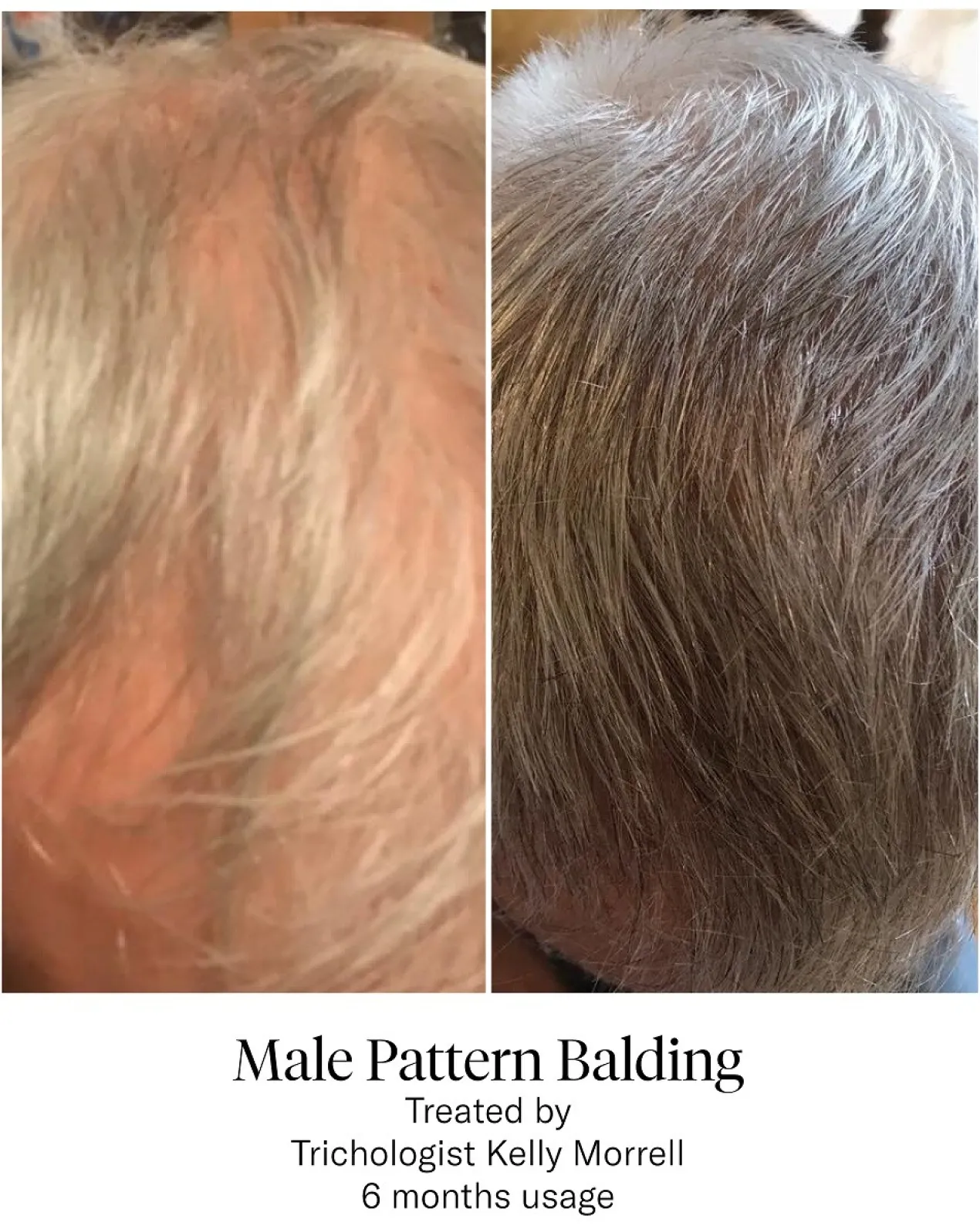 Advanced Hair System Kit Tratamento de Regeneração Capilar