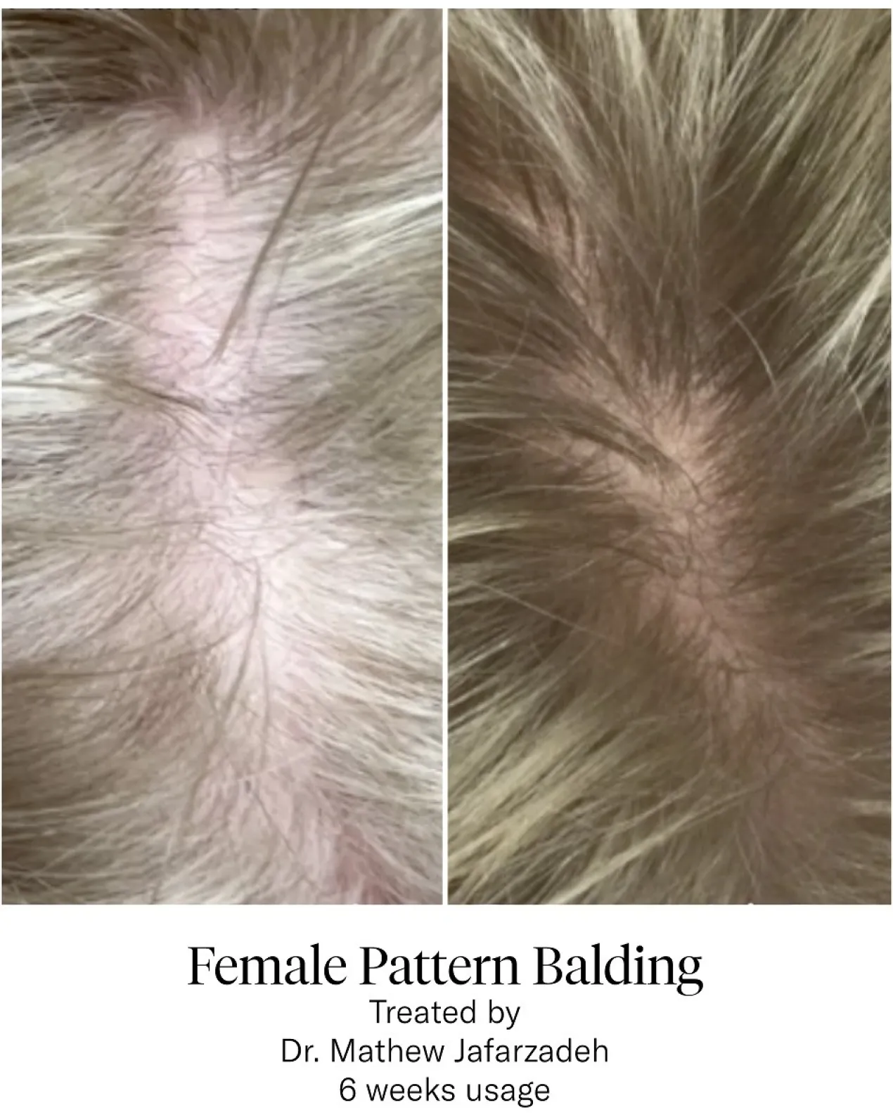 Advanced Hair System Kit Tratamento de Regeneração Capilar