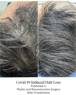 Advanced Hair System Kit Tratamento de Regeneração Capilar