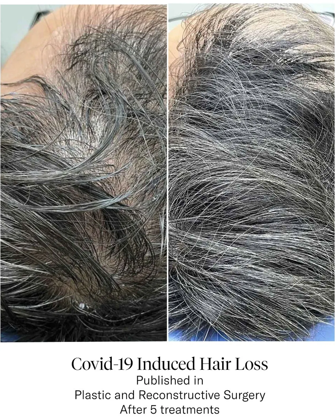 Advanced Hair System Kit Tratamento de Regeneração Capilar