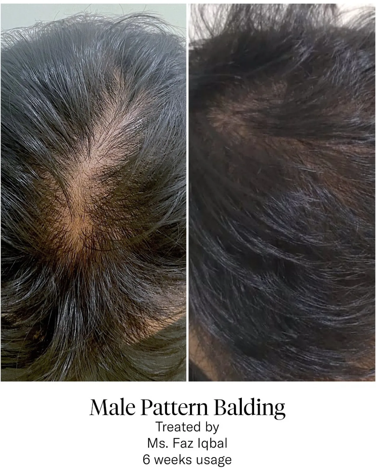 Advanced Hair System Kit Tratamento de Regeneração Capilar