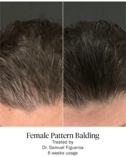 Advanced Hair System Kit Tratamento de Regeneração Capilar