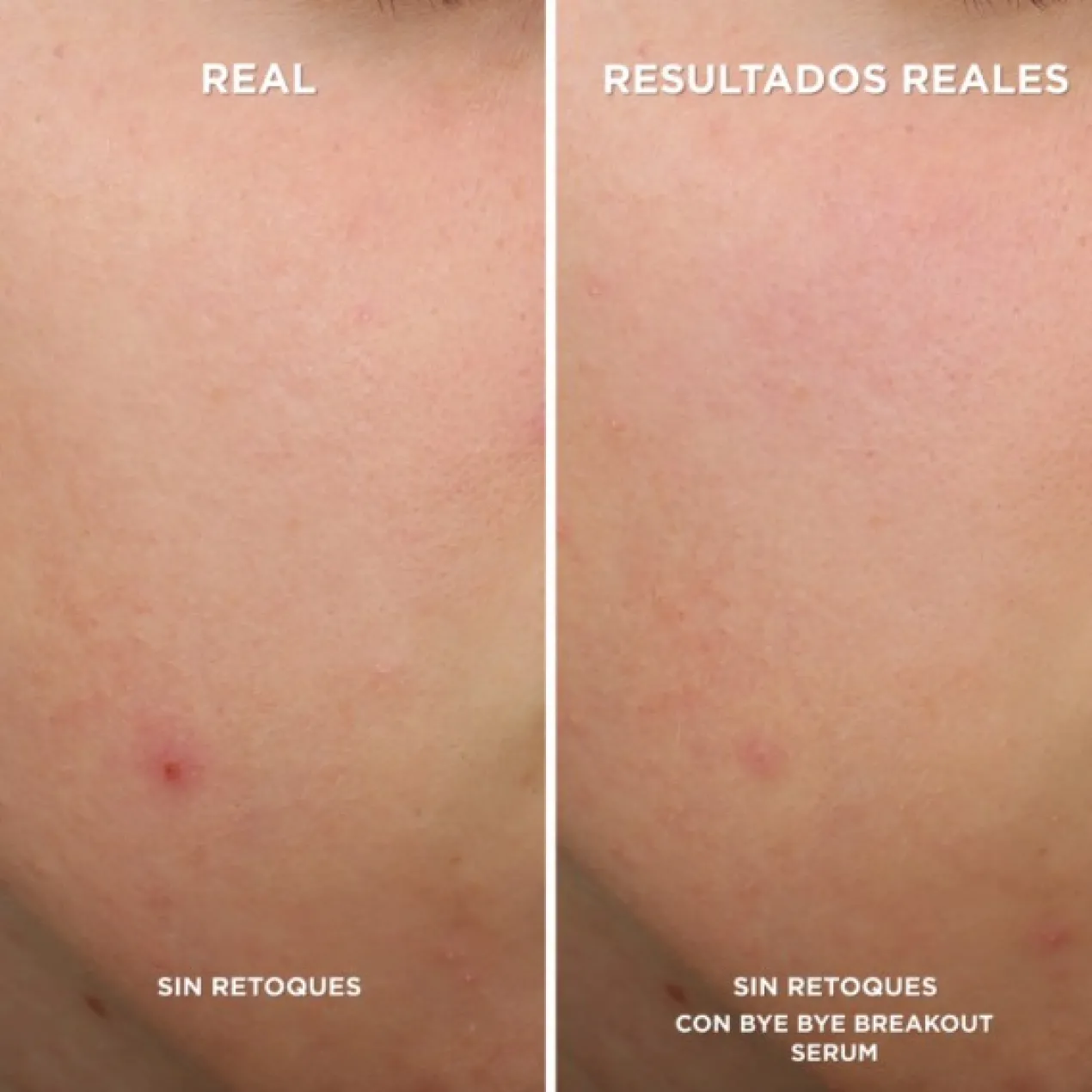 Bye Bye Breakout Sérum Antiacne