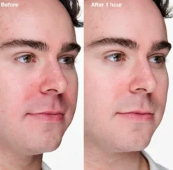 Gel Avançado Anti-Imperfeições Anti-Blemish Solutions