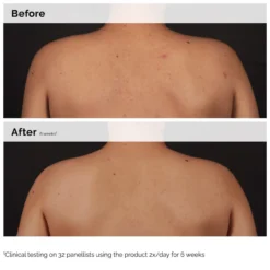 Salicylic Acid 0.5% Body Serum Anti Imperfeições