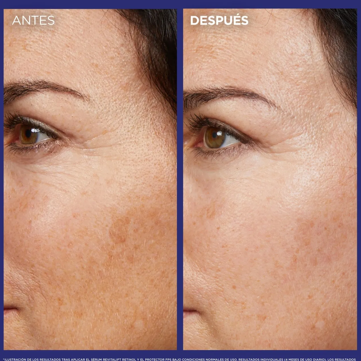 Sérum Antirrugas Noturno de Retinol Puro Revitalift Laser