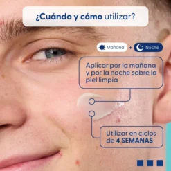 Tratamento Do Acne Concentrado Seborregulador